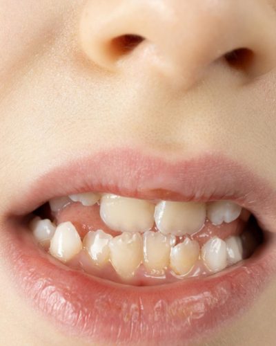 歯並び1
